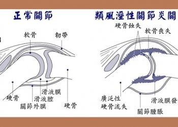 【快樂之源話健康】風濕性關節炎