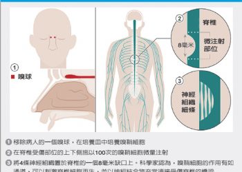 鼻細胞植入脊椎 癱男能走