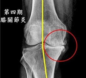 一針救膝蓋 不是人人都能打