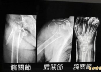 「骨鬆」平時沒癥狀 「髖部骨折」要人命