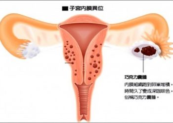 熟女怕開刀 巧克力囊腫沾黏險要命