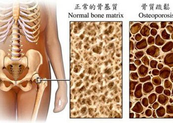【健康與衛生】預防骨質疏鬆妙方