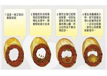 【健康與衛生】點樣可以增加體內好膽固醇