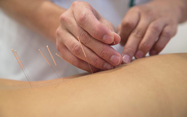 Acupuncture needles on back of a young woman