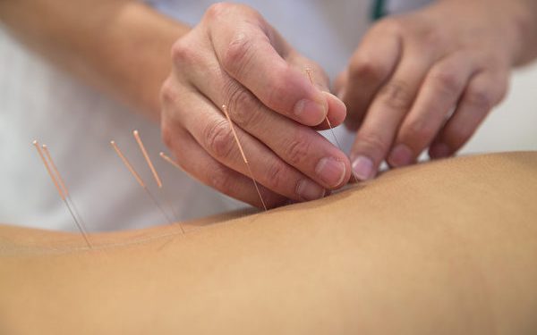 Acupuncture needles on back of a young woman
