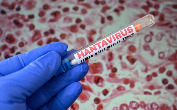 ILLUSTRATION of hantavirus testing concept with laboratory tubes containing cotton swabs and HANTAVIRUS labels photographed in front of a public domain hantavirus related microscopic image released by the US Centers for Disease Control and Prevention CDC in Paris, France, May 8 2026. (Photo by Joao Luiz Bulcao / Hans Lucas / AFP via Getty Images)